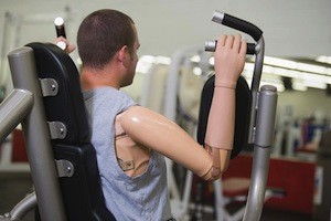 amputation amputation